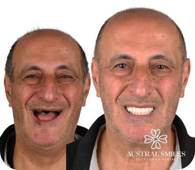 Dental Implants