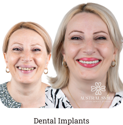 Dental Implants